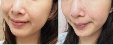 四川哪家醫(yī)院的多指手術效果好？