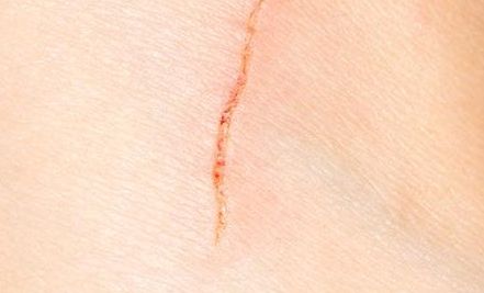 浙江開眼角哪家醫(yī)院技術好？選擇哪家醫(yī)院效果最佳