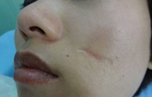 吉林市切開雙眼皮哪家好？一篇詳細的雙眼皮手術(shù)評測指南。