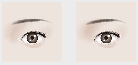 【2023年上海整形醫(yī)院哪家做眼袋好？專業(yè)醫(yī)生推薦評(píng)比】