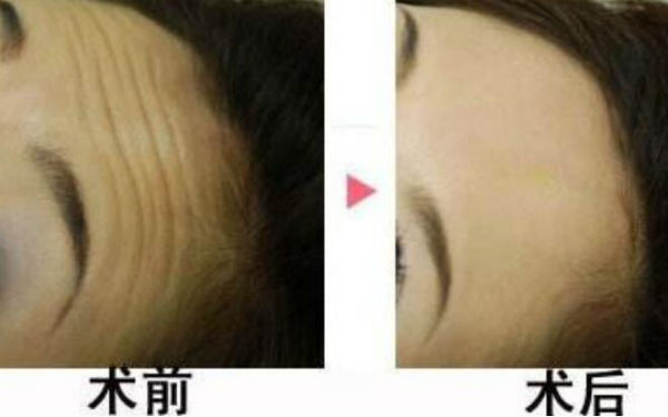 揭秘北京隆鼻領(lǐng)域的專家陳育哲、連凱峰等五位口碑扎實(shí)的權(quán)威專家