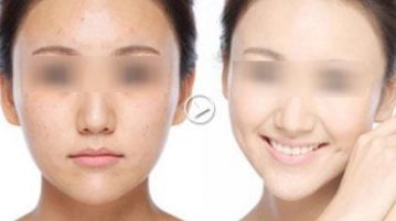 廣州哪家醫(yī)院去黑頭好？揭秘廣州專(zhuān)業(yè)祛黑頭效果最佳的醫(yī)療機(jī)構(gòu)