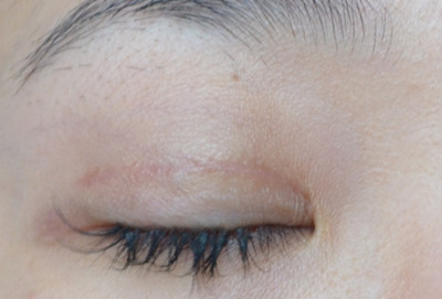 2023上海嗨體去抬頭紋排名前十的專家(張芝演、董佳生、李鎬均這些正規(guī)專家推薦給你)