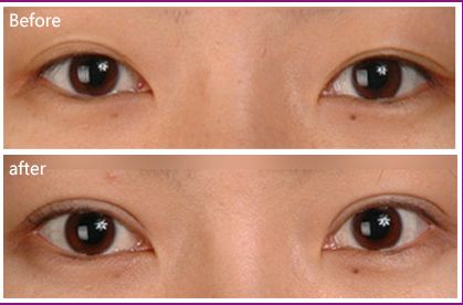 深圳墊鼻梁哪家醫(yī)院技術(shù)好且口碑可信？