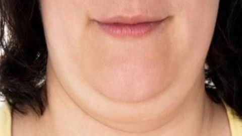 吳佳君醫(yī)生拉皮技術(shù)獨步一時，值得信賴嗎？費用如何計算？