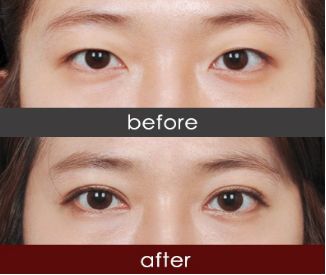 恩施市哪家醫(yī)院注射除皺針效果好推薦？