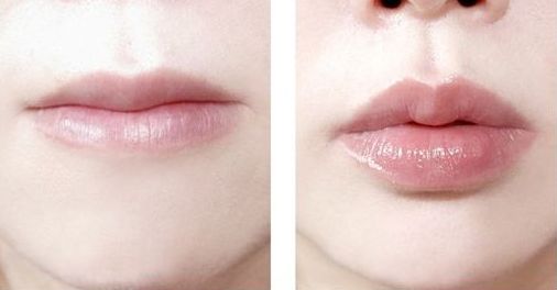 南京哪家醫(yī)院治療黃褐斑效果好？