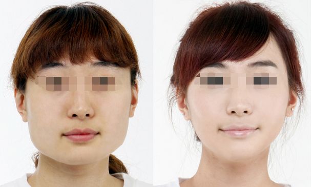 合肥哪家醫(yī)院豐胸效果好，專業(yè)的豐胸醫(yī)院推薦