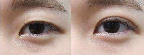 寧波市眼袋手術哪家醫(yī)院好？