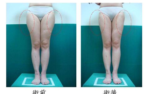 杭州做埋線哪家醫(yī)院好？選擇正規(guī)專業(yè)的醫(yī)療機(jī)構(gòu)，安全可靠！