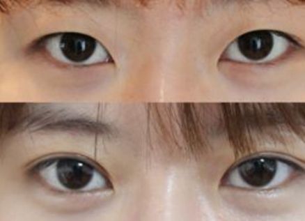 杭州去咖啡斑好的醫(yī)院有哪些？