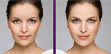 淮安雙眼皮手術(shù)哪家好？推薦淮安哪家醫(yī)院做雙眼皮手術(shù)效果好