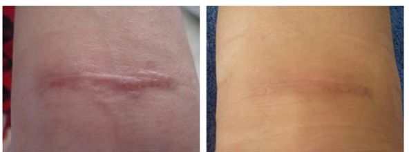 廣州治疤痕醫(yī)院專家推薦，哪家治疤痕效果好？