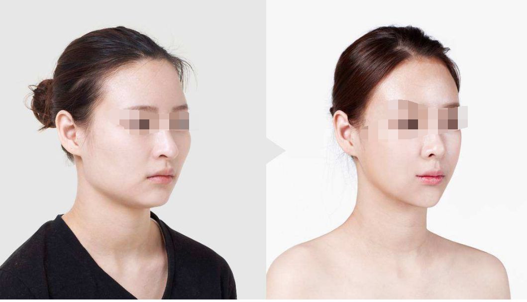 膠原蛋白面部填充持續(xù)效果及價格解析