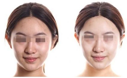 處女膜修復(fù)的方法及注意事項(xiàng)