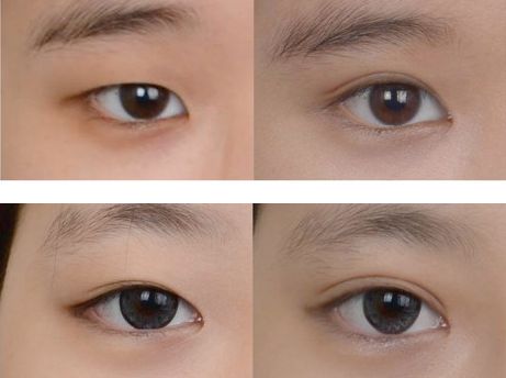 修復(fù)過寬雙眼皮手術(shù)，寬度調(diào)整方案推薦