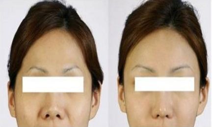 男生開始關(guān)注臀部美容，吸脂豐臀自體脂肪成熱潮！你還在猶豫？