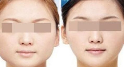 體脂填充修復(fù)乳房失敗后的方法與費(fèi)用