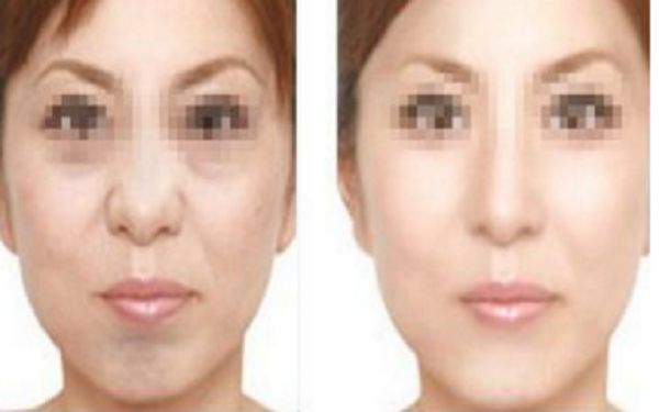 眼袋手術(shù)后疤痕何時(shí)消失？手術(shù)后禁食期應(yīng)該如何安排？