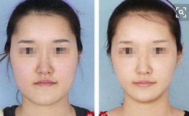 美容拉皮手術(shù)費用受這3個因素影響，術(shù)前必看攻略大揭秘