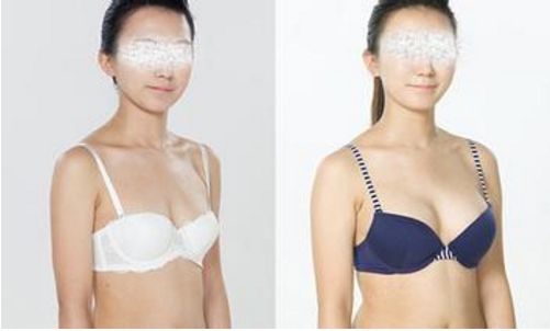 如何判斷合適的割雙眼皮寬度