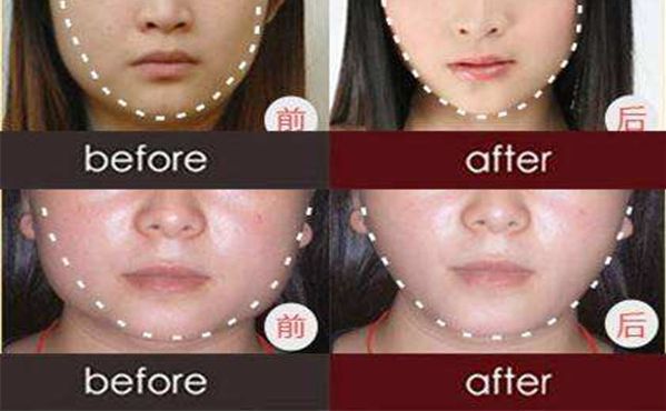 上海瑞東隆鼻注射價格查詢，鼻部整形的費用是多少？