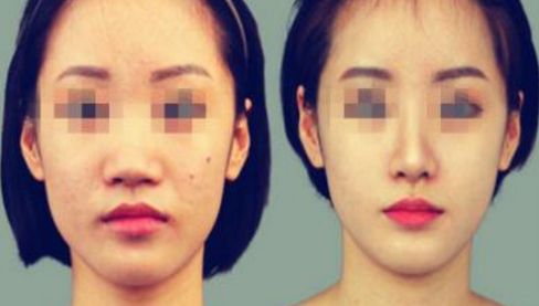 養(yǎng)成美鼻的6個關(guān)鍵步驟，完美修復(fù)效果在您的掌握！