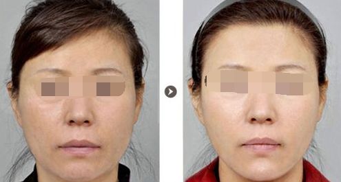 7D眼袋去除效果如何優(yōu)越