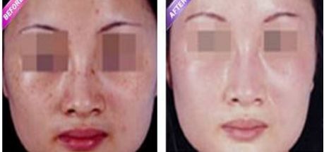 激光縮陰是否會導(dǎo)致副作用？找到安全有效的解決方法