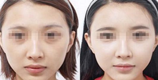 容城洗牙價格一覽，潔牙需花多少錢？