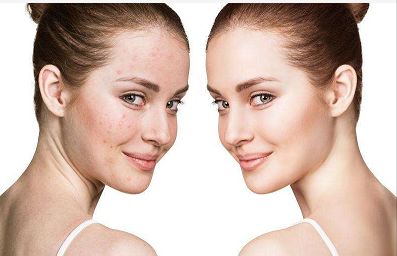 雙眼皮手術(shù)失敗如何修復(fù)？有效解決方法分享！