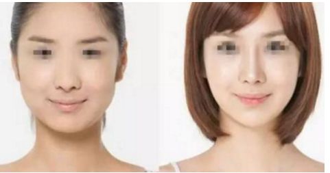 威寧隆胸手術(shù)效果如何？術(shù)后持久無需擔(dān)心！