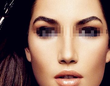 透明質(zhì)酸隆鼻后是否可以自由按壓鼻子？