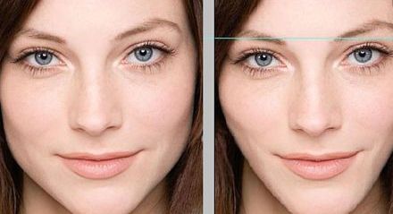 透明質(zhì)酸隆鼻：步驟詳解，效果驚艷！