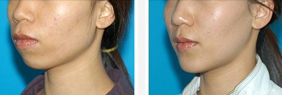 隆鼻手術失敗修復的安全解決方法