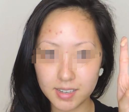 延長透明質(zhì)酸隆鼻效果，多種小竅門讓您保持完美鼻形