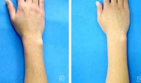 腹部吸脂手術是否存在副作用？