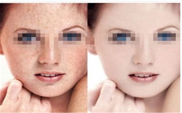 吸脂手術(shù)對(duì)于減肥有哪些顯著效果呢？