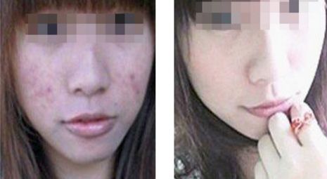 危害程度如何？全方位解析臉部拉皮手術(shù)風(fēng)險(xiǎn)與安全