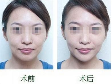 隆鼻手術(shù)使用透明質(zhì)酸須知