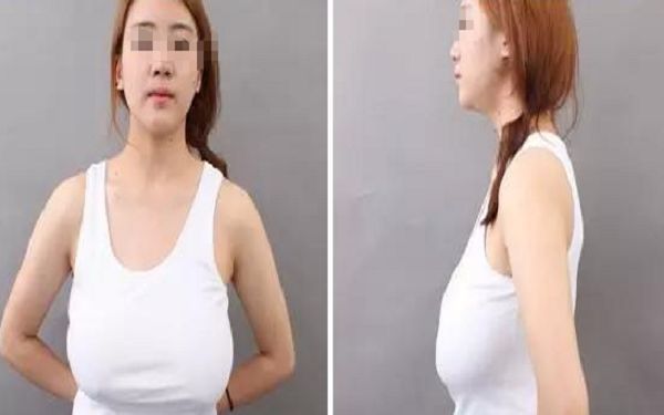 如何避免失敗的隆鼻整形？