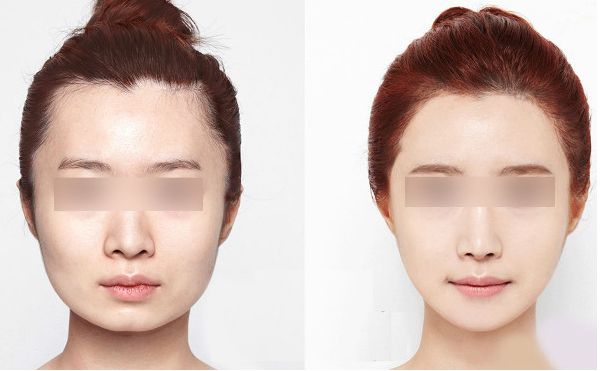 無(wú)創(chuàng)超聲炮與傳統(tǒng)超聲炮的對(duì)比及價(jià)格解析