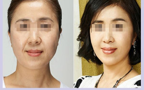 了解烤瓷牙材料，探究?jī)r(jià)格背后的價(jià)值點(diǎn)！