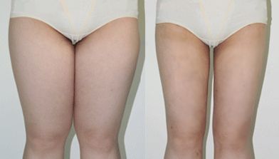 利用腹部吸脂手術(shù)塑造完美曲線