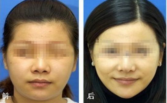 透明質(zhì)酸隆鼻價(jià)格多少？?jī)r(jià)位調(diào)查報(bào)告來(lái)襲！