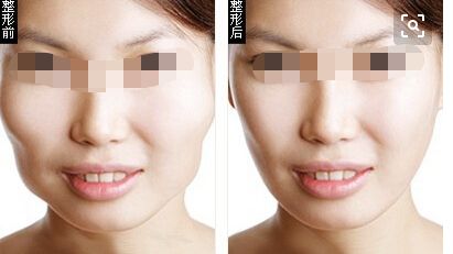 假體隆胸植入多久需要更換？