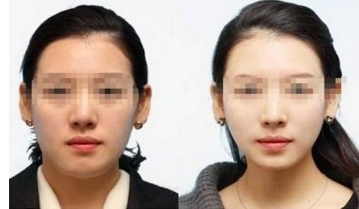 彩光嫩膚：一個(gè)療程要多少次才有效？