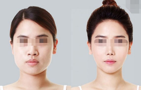 雙眼皮消腫速度？這個(gè)方法幫你快速恢復(fù)！