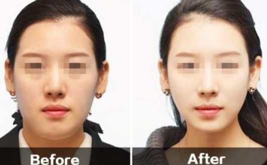 神奇的無痛拉皮術(shù)，秀出無瑕年輕面龐！點擊了解相關(guān)知識！
