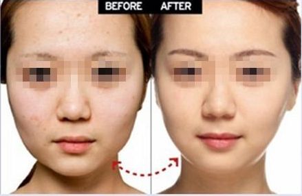 開(kāi)外眼角手術(shù)：提升臥蠶、增大眼睛，效果有多好？